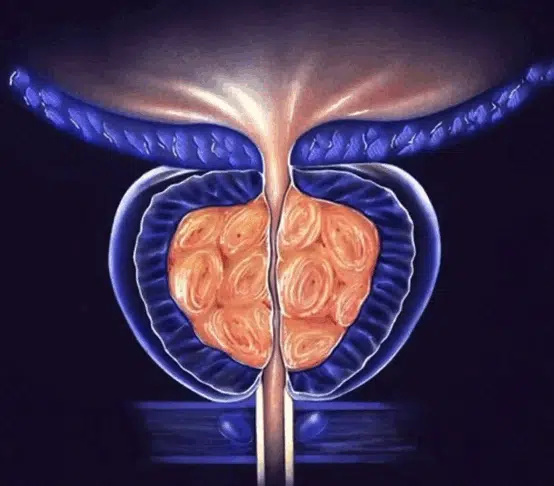 Боль при простатите